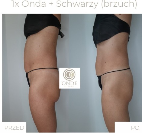 1 x Onda + Schwarzy